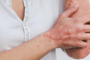 Potret ilustrasi cacar monyet atau monkeypox